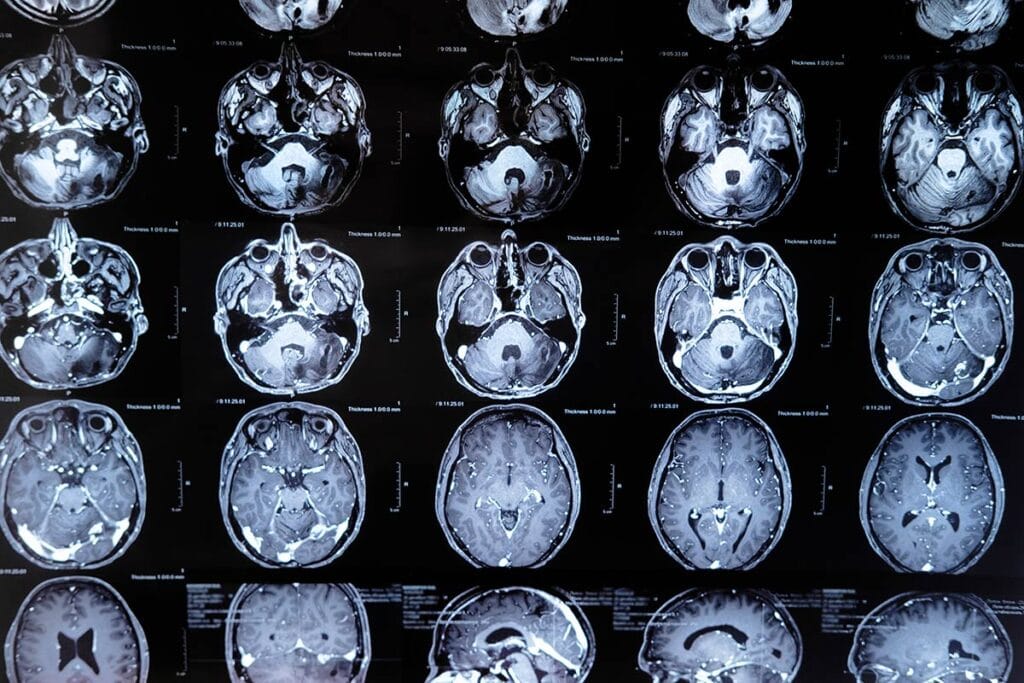 The image captures results of MRI testing of a patient who underwent nonfatal opioid overdose