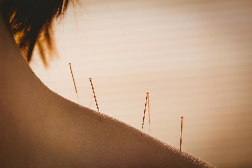 Image of acupuncture needles inserted in patient skin in an attempt to subdue the withdrawal effects of drug addiction